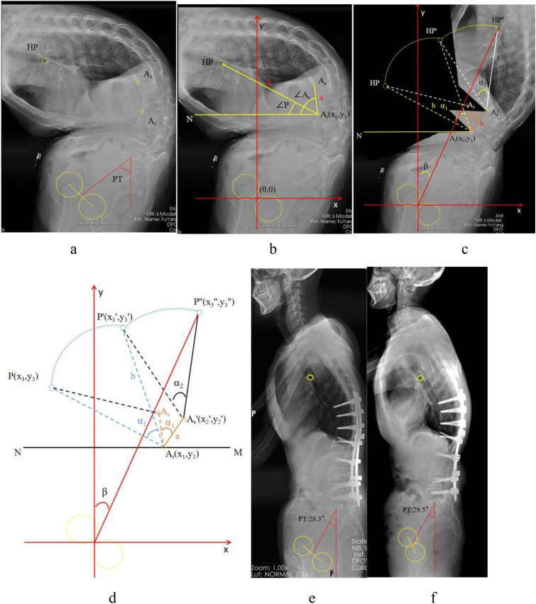 Novel mathematical model for preoperatively predicting pelvic tilt in patients with thoracolumbar kyphosis due to ankylosing spondylitis after three-column osteotomy.