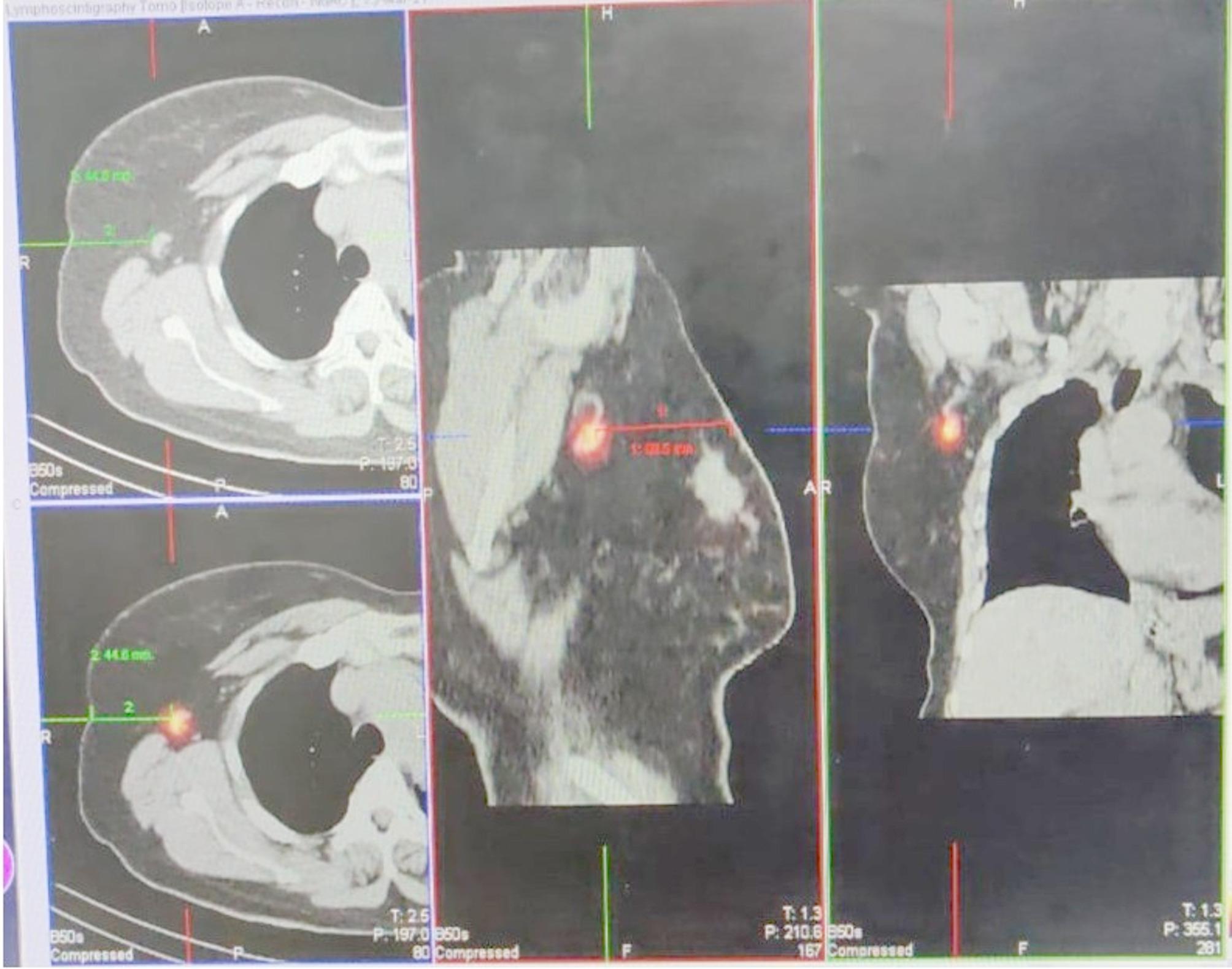 Performing sentinel lymph node biopsy without a hand-held gamma probe - overcoming hurdles through team work: an analysis of our learning curve over five years.