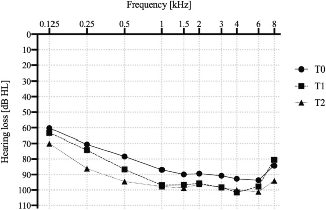 Cochlear implantation with Slim Modiolar Electrode carriers enables hearing preservation.