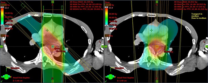 Radiotherapy treatment planning for esophageal cancer: JASTRO guidelines 2024 for radiotherapy treatment planning.