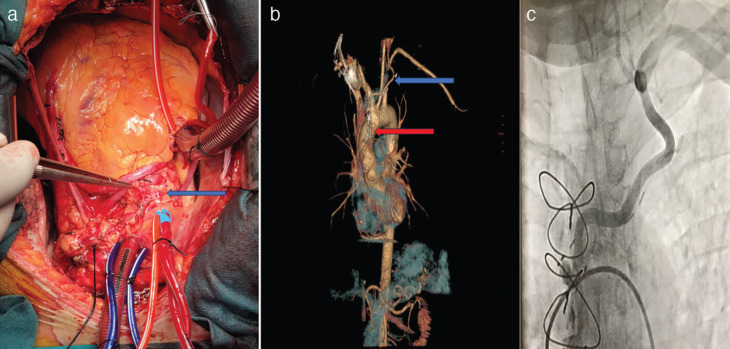 A Novel Approach for the Treatment of Subclavian Steal Syndrome in a Patient Undergoing Coronary Artery Bypass Grafting