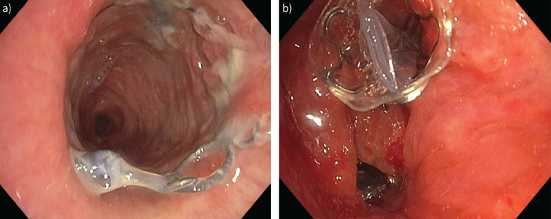 Lung implantable devices: the issue with granulation tissue.
