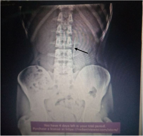Successful endoscopic removal of sewing needle and flat metal: a case report.