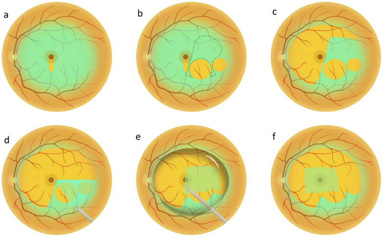 Controversies, consensuses, and guidelines on macular hole surgery by the Asia-Pacific Vitreo-retina Society (APVRS) and the Asia-Pacific Academy of Professors in Ophthalmology (AAPPO).