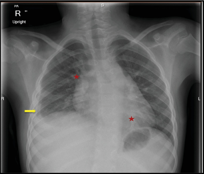 Familial Mediterranean Fever as a Cause of Recurrent Pleurisy in a Child With Crohn's Disease: A Case Report.
