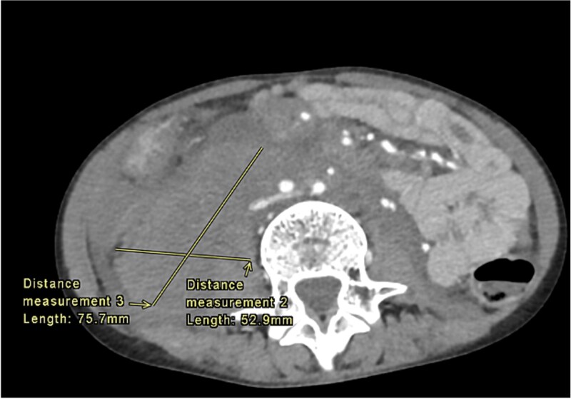 'Pediatric Ehlers-Danlos syndrome VI with retroperitoneal Hemorrhage: case report and management strategy'.