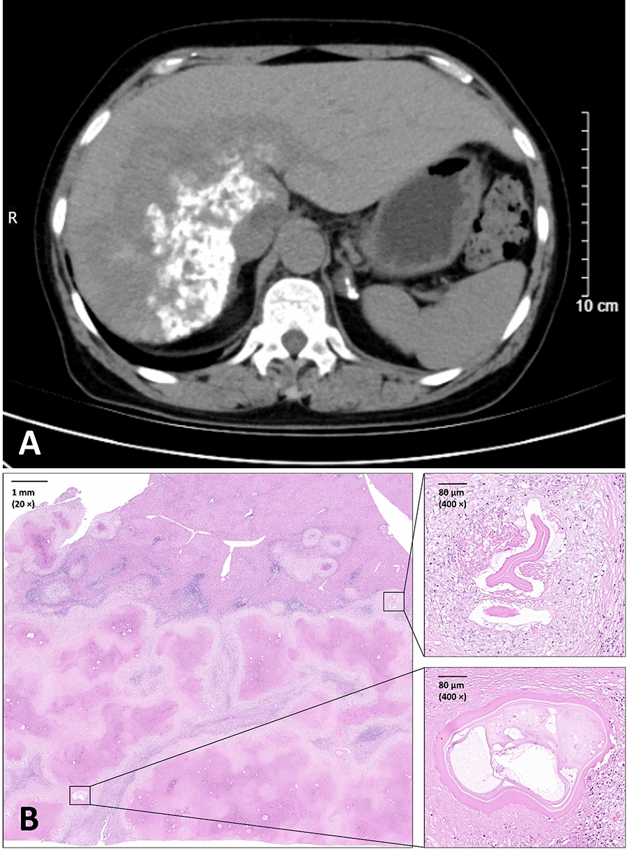 Clinical confirmation of an infection with Echinococcus multilocularis (Mongolian genotype): first case report of human alveolar echinococcosis in Inner Mongolia, China.