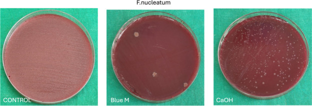 Antimicrobial efficacy of blueM gel and calcium hydroxide against F. nucleatum and E. faecalis biofilm: an ex-vivo study.
