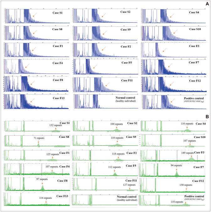 Diverse Clinical Phenotypes of Neuronal Intranuclear Inclusion Disease in South Korea.