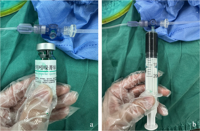 Application of indocyanine green fluorescence angiography in laparoscopic sleeve gastrectomy: preliminary results.