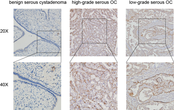 Functional study of laminin subunit α5 in high-grade serous ovarian cancer.