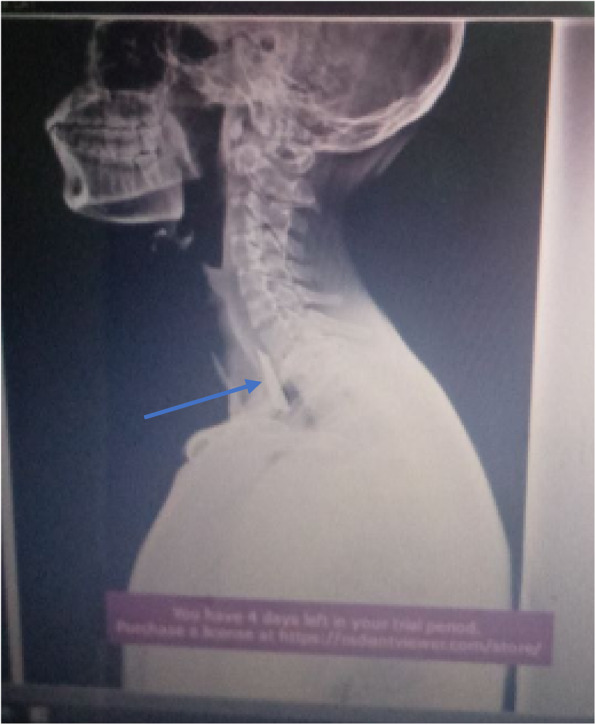 Successful endoscopic removal of sewing needle and flat metal: a case report.