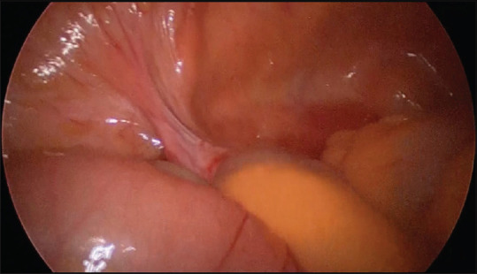 An unusual case of small-bowel obstruction: Broad ligament hernia.