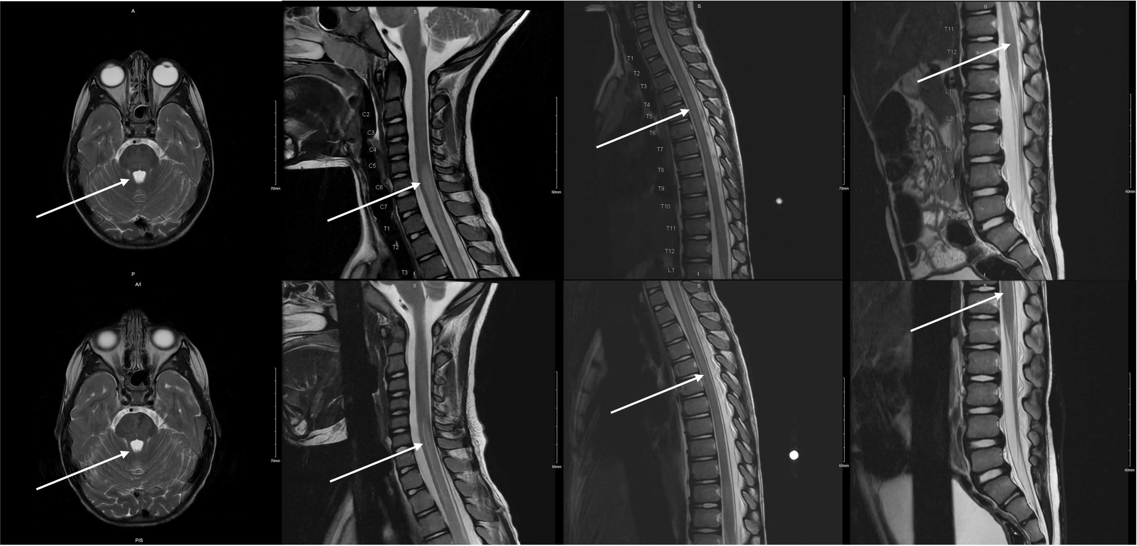 Beware of the Pediatric Limp: A Case of <i>Mycoplasma</i> Associated Acute Transverse Myelitis.