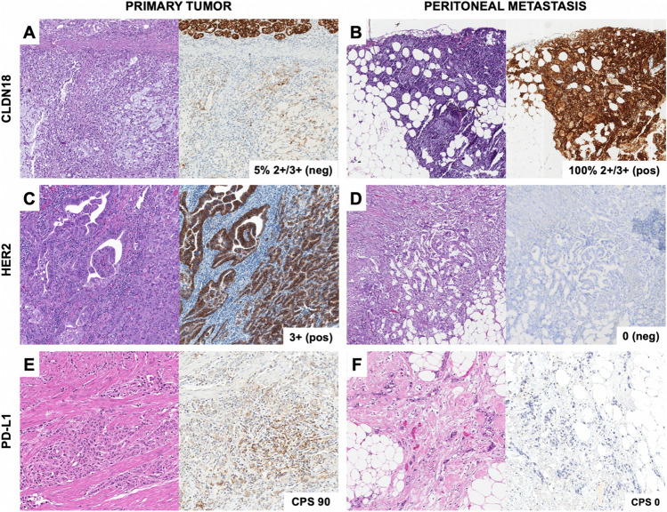 Heterogeneity of predictive biomarker expression in gastric and esophago-gastric junction carcinoma with peritoneal dissemination.
