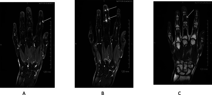 Clinical Images: Magnetic resonance imaging changes of bone marrow edema in the hands in Raynaud phenomenon.