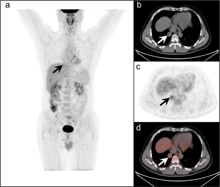 Characterization of Pulmonary Sclerosing Pneumocytoma Assessed by <sup>18</sup>F-FDG PET/CT.