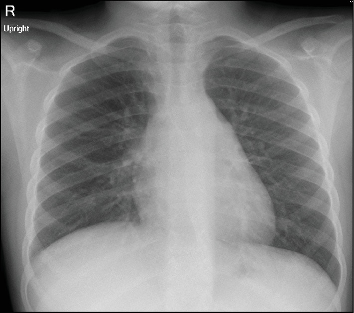 Familial Mediterranean Fever as a Cause of Recurrent Pleurisy in a Child With Crohn's Disease: A Case Report.