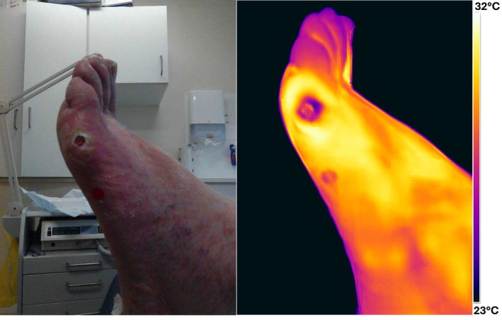 Wound Bed Temperature has Potential to Indicate Infection Status: A Cross-Sectional Study.