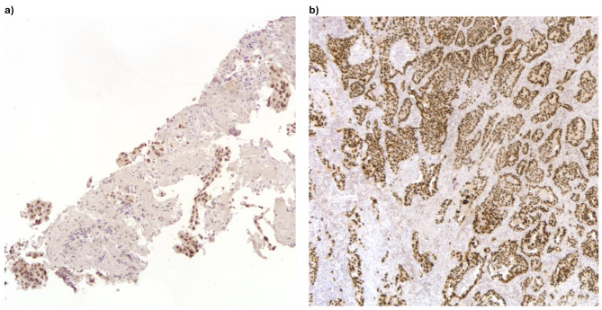 p53 aberrant expression is pervasive in pleomorphic carcinomas of the lung and a sensitive diagnostic adjunct for biopsy specimens.
