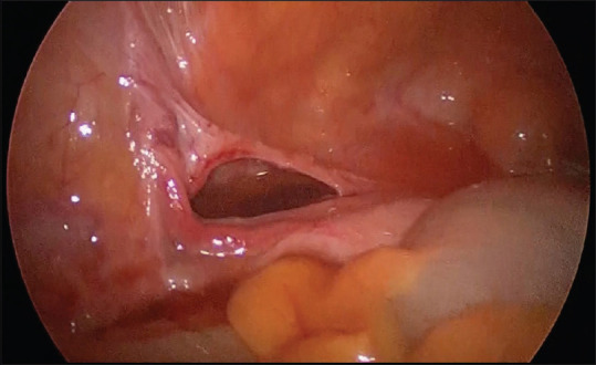 An unusual case of small-bowel obstruction: Broad ligament hernia.