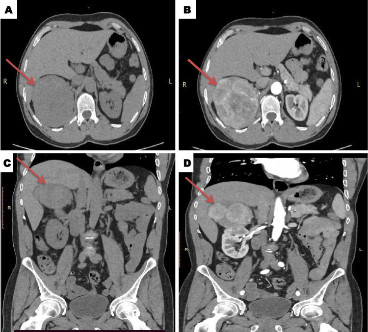 Resolution of Refractory Hypertension Following Radical Nephrectomy for Renal Cell Carcinoma: A Case Report from Somalia in Resource Limit Setting.