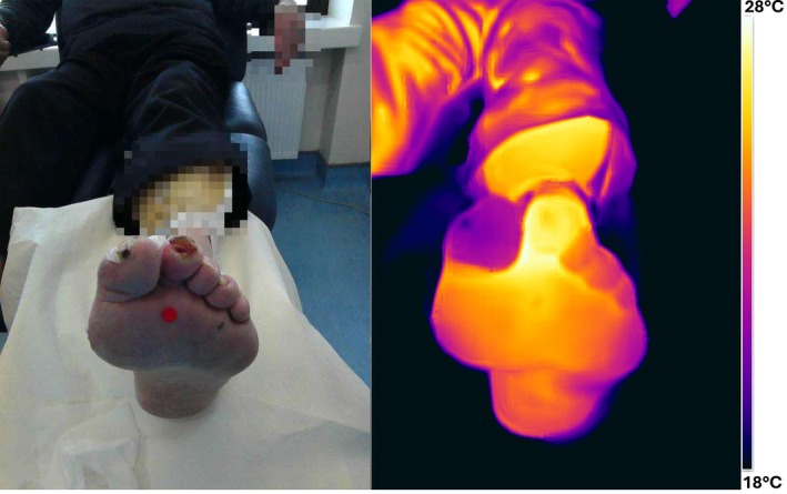 Wound Bed Temperature has Potential to Indicate Infection Status: A Cross-Sectional Study.