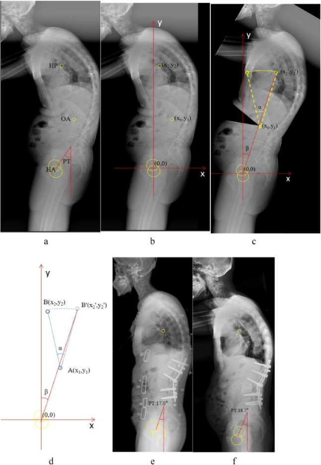 Novel mathematical model for preoperatively predicting pelvic tilt in patients with thoracolumbar kyphosis due to ankylosing spondylitis after three-column osteotomy.