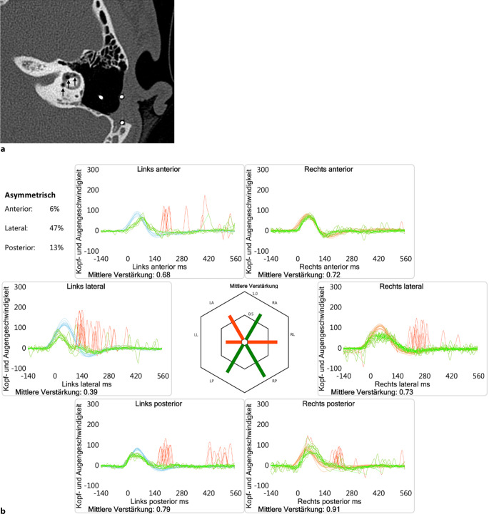 [Pneumolabyrinth after barotrauma in a patient with cochlear implants].