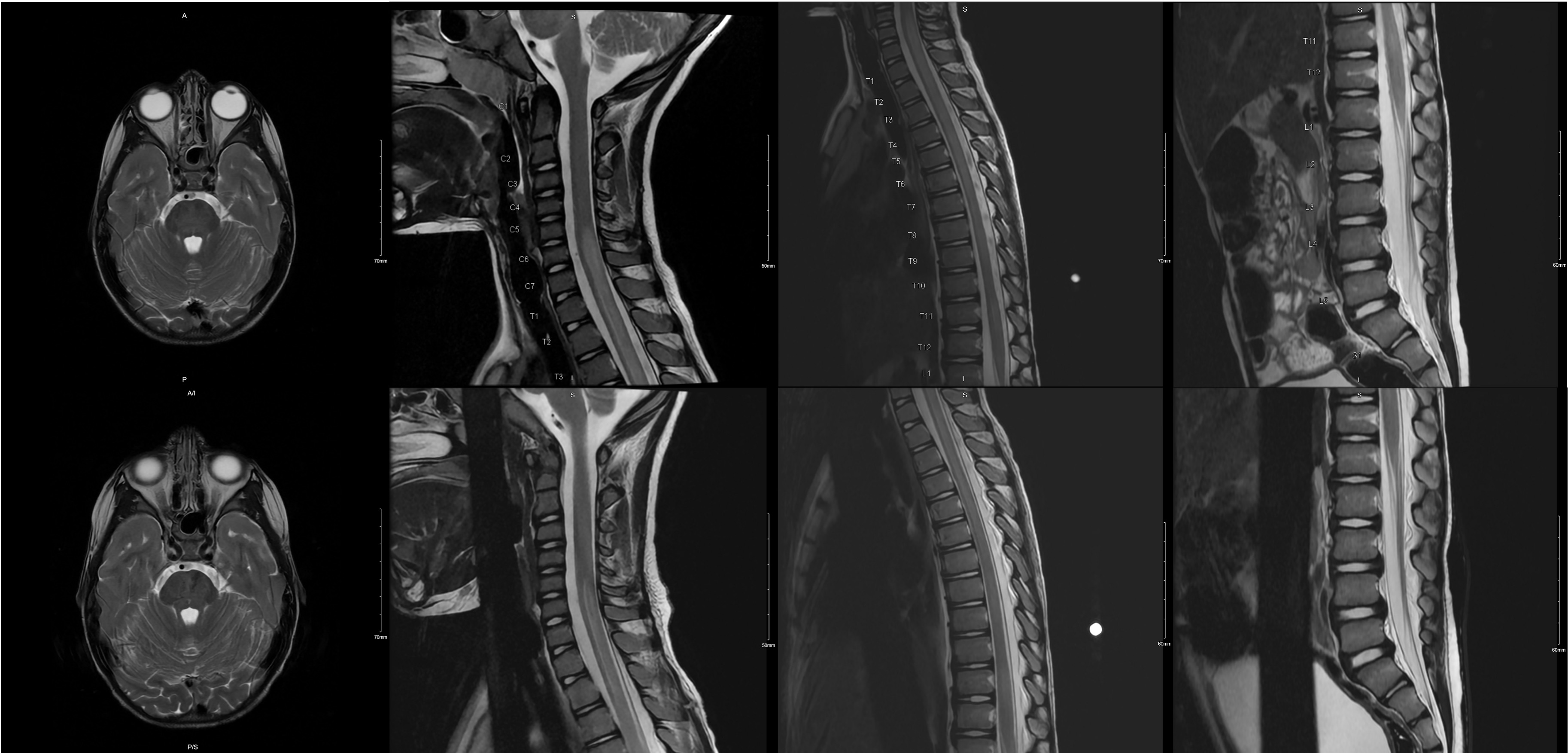 Beware of the Pediatric Limp: A Case of <i>Mycoplasma</i> Associated Acute Transverse Myelitis.