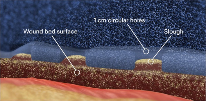 Effectiveness of Negative Pressure Wound Therapy With Instillation and Dwell in Removing Nonviable Tissue, Promoting Granulation Tissue, and Reducing Surgical Debridements: A Systematic Literature Review.