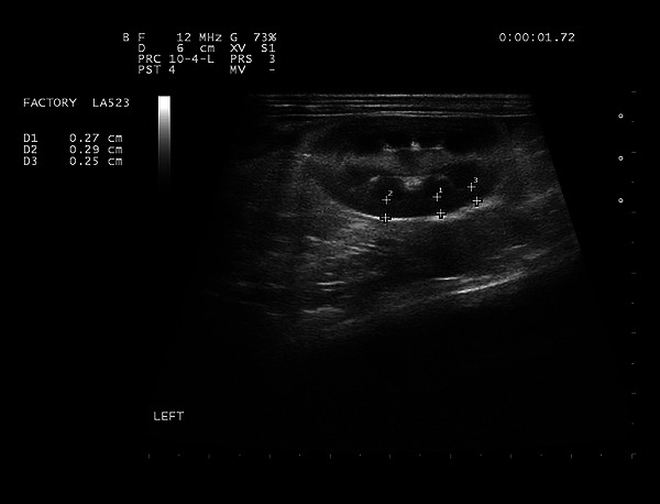 Ultrasonographic Measurement of the Renal Cortical Thickness-to-Abdominal Aortic Ratio in Healthy Rabbits.