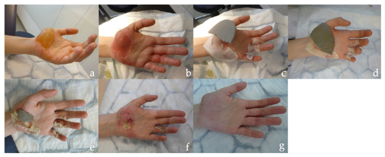 Can Pure Silk Compete with the Established Mepilex Ag<sup>®</sup> in the Treatment of Superficial Partial Thickness Burn Wounds? A Prospective Intraindividual Study.