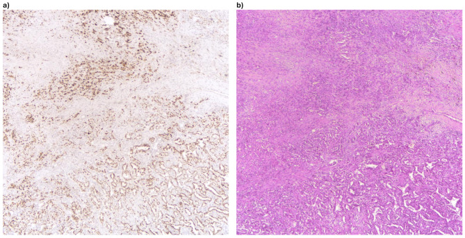 p53 aberrant expression is pervasive in pleomorphic carcinomas of the lung and a sensitive diagnostic adjunct for biopsy specimens.