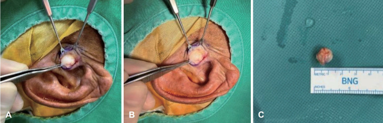 Isolated Myxoma of the External Auditory Canal: A Rare Case Report.
