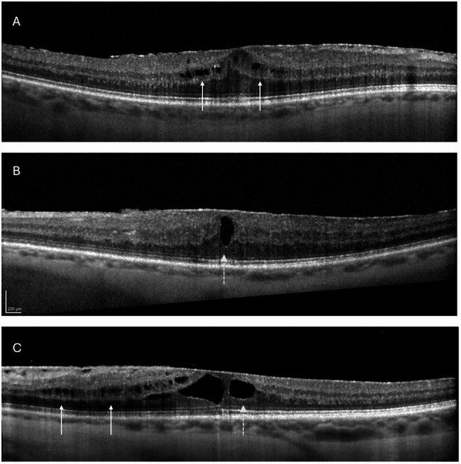 The impact of epiretinal membrane stage and postoperative treatment on visual and anatomical outcomes following vitrectomy in eyes with preexisting macular edema.