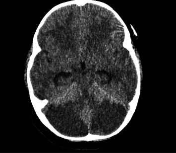 Accidental Methadone Toxicity in a 3-Year-Old Leading to Severe Cerebellitis and Death: A Case Report.