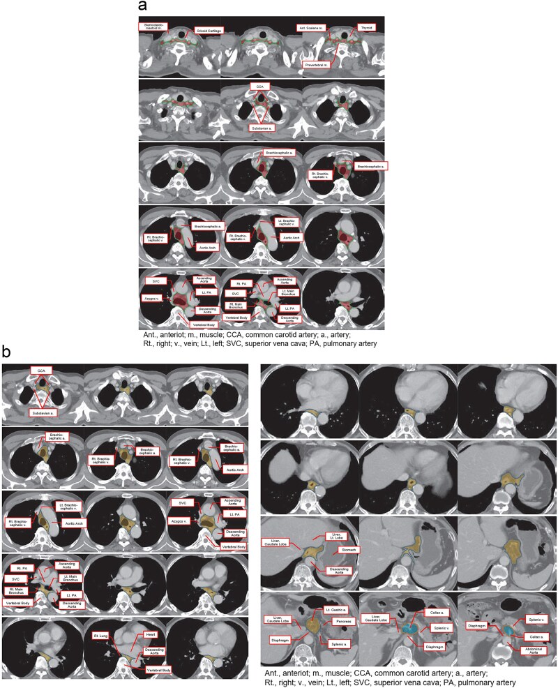 Radiotherapy treatment planning for esophageal cancer: JASTRO guidelines 2024 for radiotherapy treatment planning.