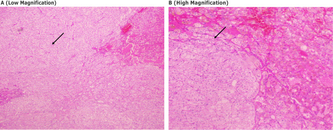 Resolution of Refractory Hypertension Following Radical Nephrectomy for Renal Cell Carcinoma: A Case Report from Somalia in Resource Limit Setting.