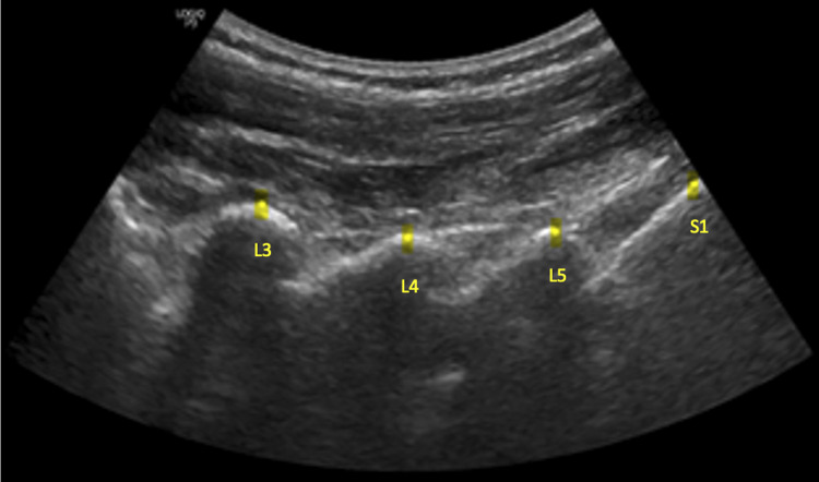 Ultrasound measurements of lumbar spinous process movement during flexion distraction manipulation: a preliminary descriptive cross-sectional study with healthy participants.