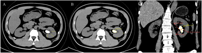 Prediction of postoperative SIRS risk factors in MetS patients undergoing PCNL.