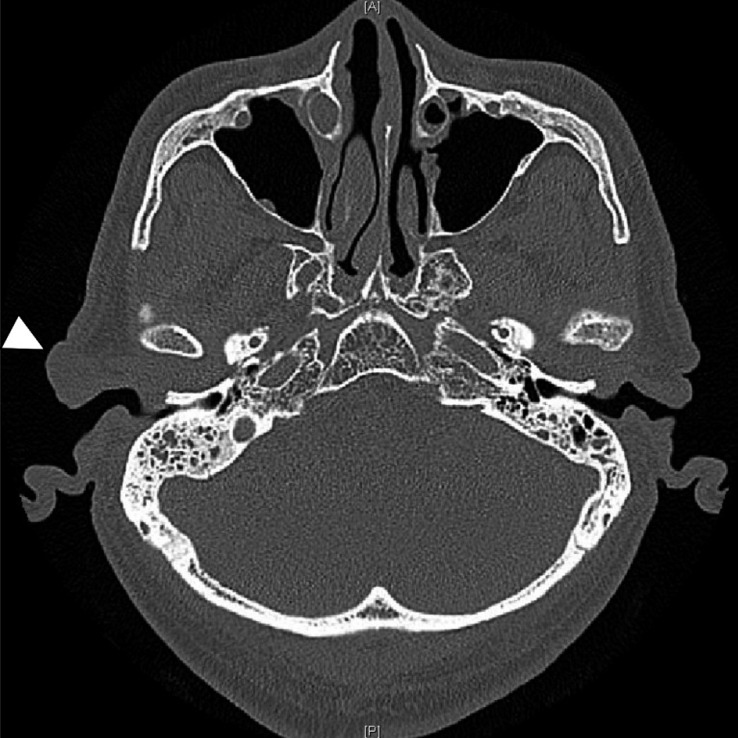 Isolated Myxoma of the External Auditory Canal: A Rare Case Report.