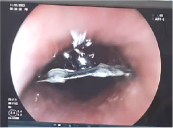 Successful endoscopic removal of sewing needle and flat metal: a case report.