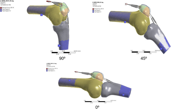 Finite Element Analysis of Patellofemoral Contact Pressure with Varying Fixation of Transverse Patella Fractures.