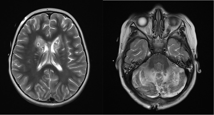 Accidental Methadone Toxicity in a 3-Year-Old Leading to Severe Cerebellitis and Death: A Case Report.
