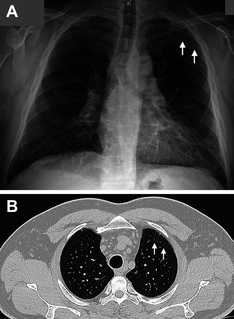 A ceramic worker diagnosed with Sjögren's syndrome.