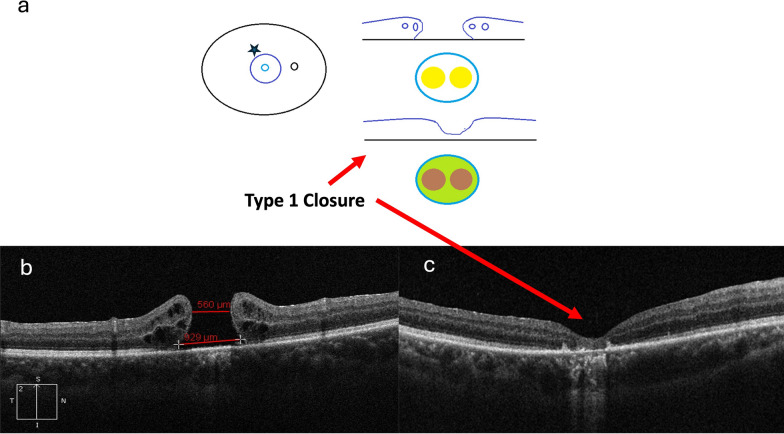 Controversies, consensuses, and guidelines on macular hole surgery by the Asia-Pacific Vitreo-retina Society (APVRS) and the Asia-Pacific Academy of Professors in Ophthalmology (AAPPO).