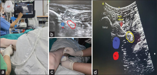 Ultrasound-guided supine lateral CAPS (crosswise approach to popliteal sciatic) block for below-knee surgeries in high-risk patients: A retrospective case series.
