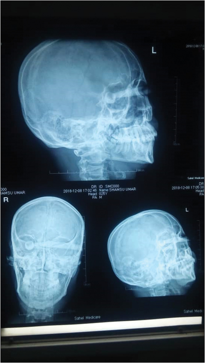 Intra-orbital Foreign Body.
