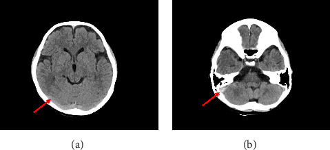 Pediatric Posttraumatic Cerebral Venous Sinus Thrombosis: Successful Resolution With Rivaroxaban.